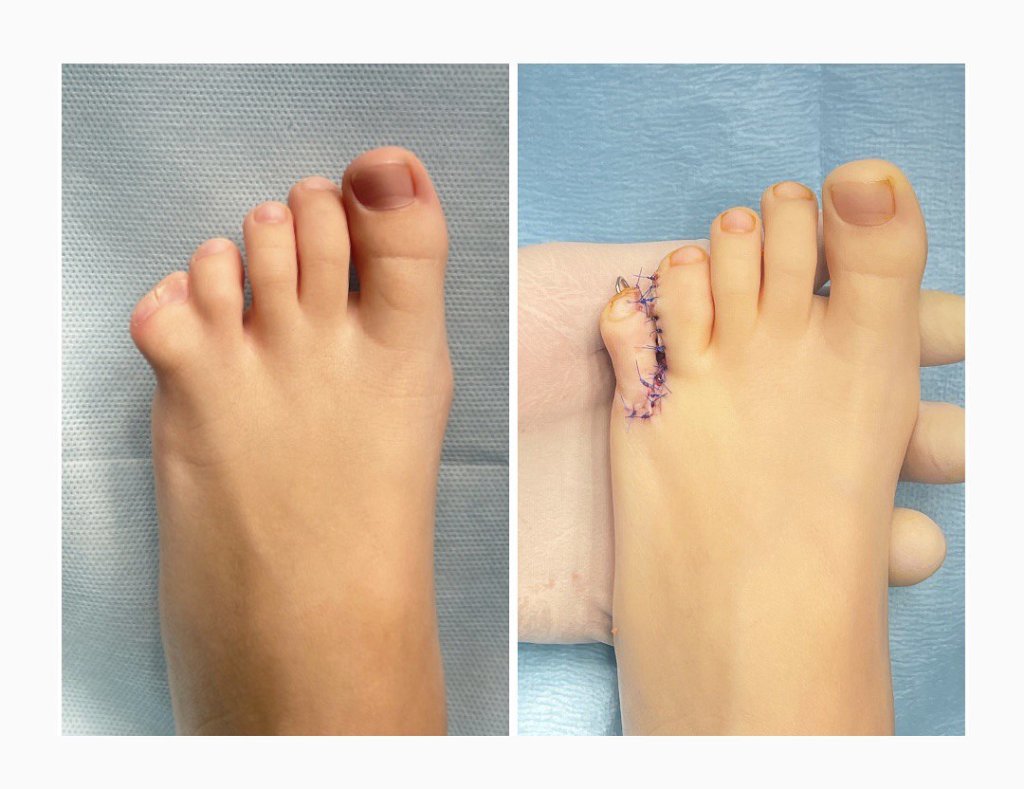 Полидактилия.jpg Полидактилия.jpg