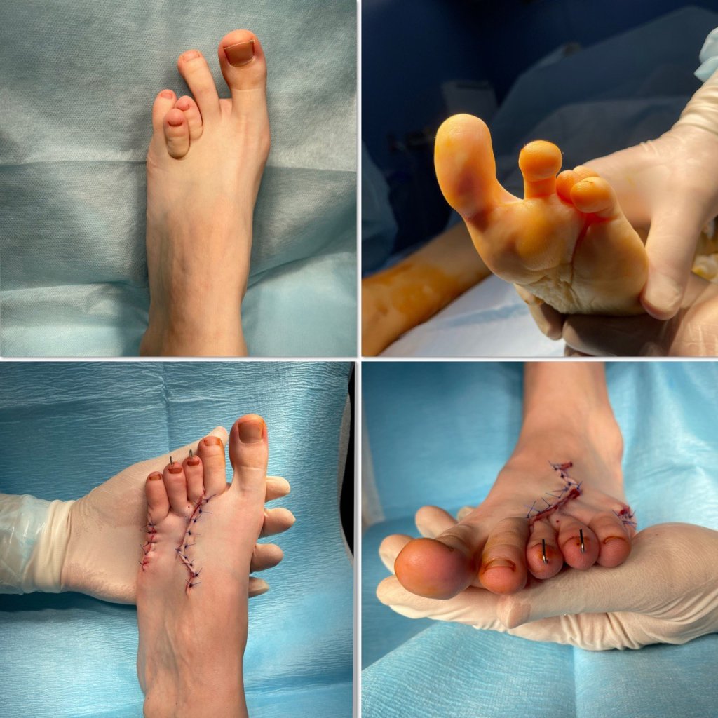 Лечение брахиметатарзии_2.jpg Лечение брахиметатарзии_2.jpg