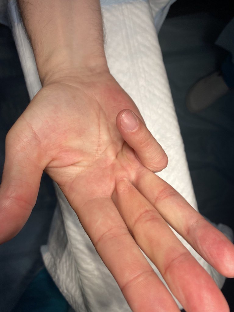 Иссечение контрактуры_1.jpg Иссечение контрактуры_1.jpg