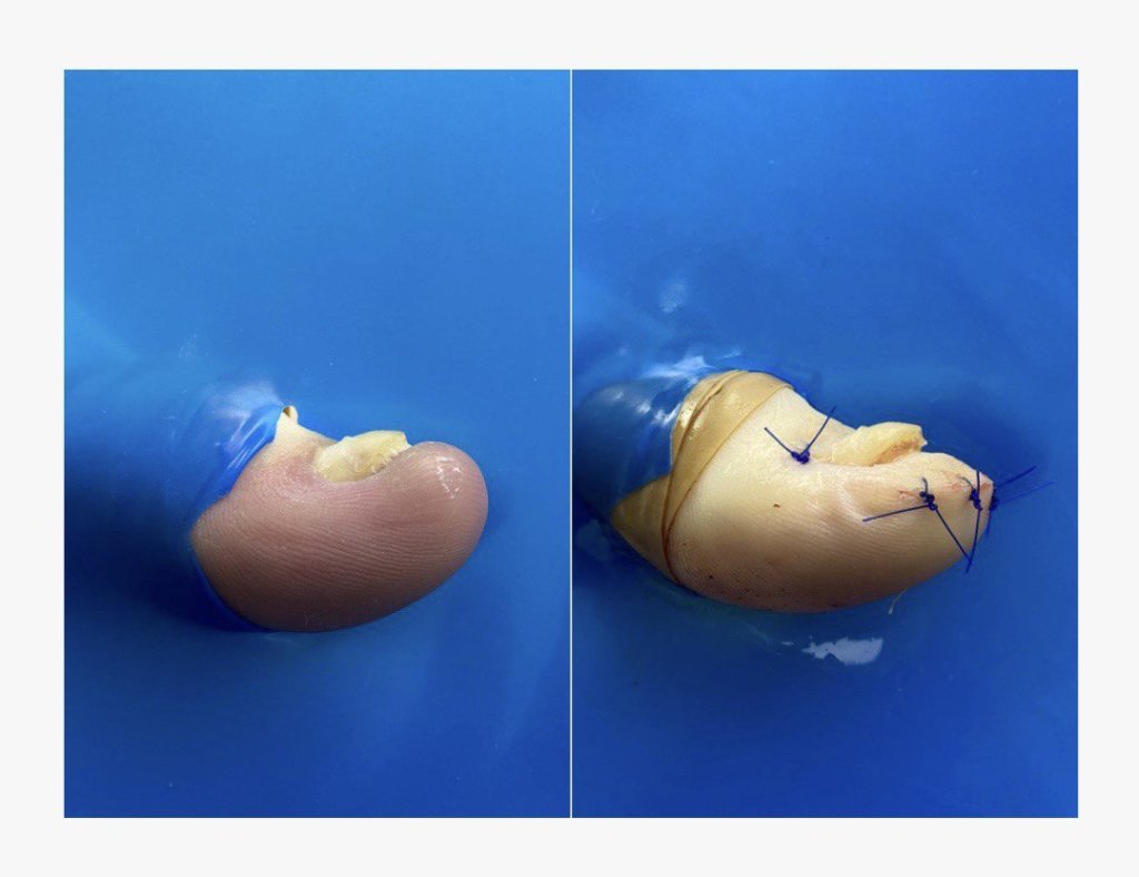 Удаление подногтевого экзостоза.jpg Удаление подногтевого экзостоза.jpg