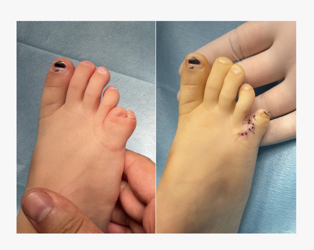 Коррекция синдактилии.jpg Коррекция синдактилии.jpg