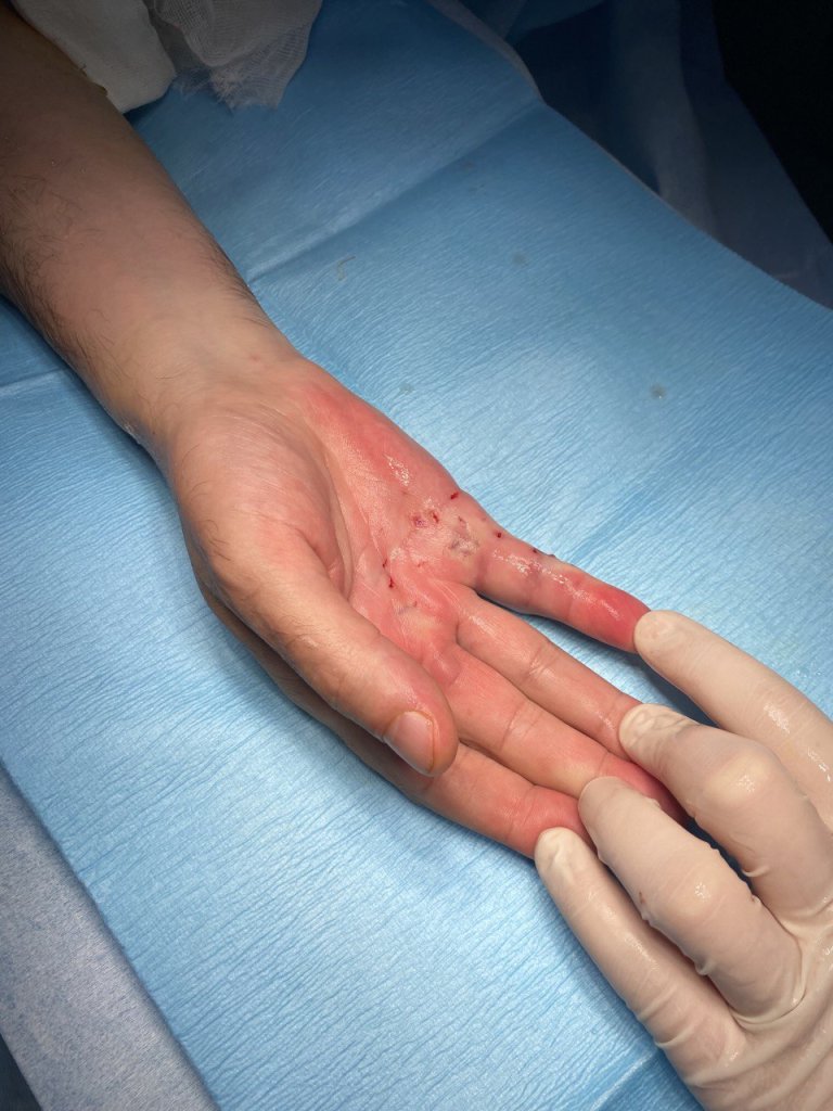 Иссечение контрактуры_2.jpg Иссечение контрактуры_2.jpg