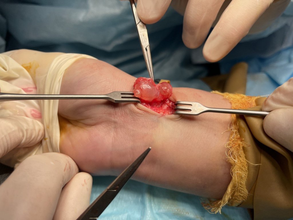 Удаление гигромы_3.jpg Удаление гигромы_3.jpg