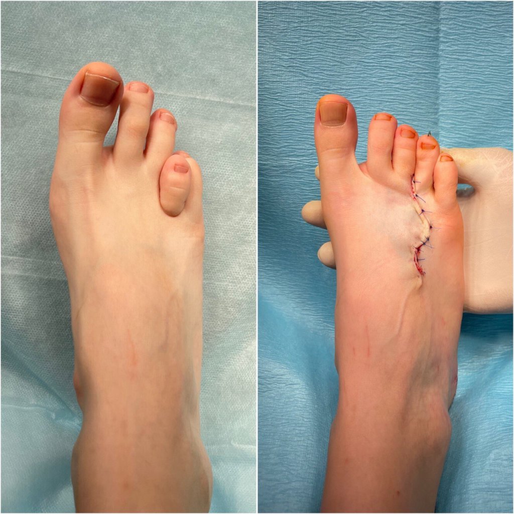 Лечение брахиметатарзии_1.jpg Лечение брахиметатарзии_1.jpg